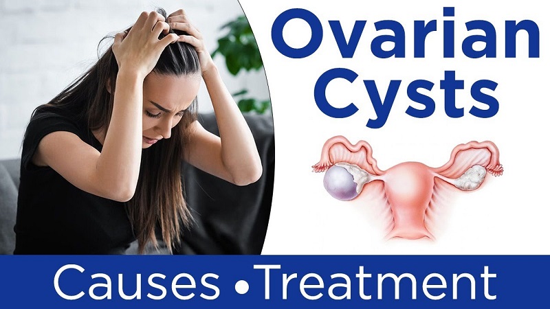 Ovarian Cyst